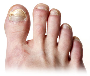 Ingrown, Impacted & Damaged Toe Nails | JD Cowen Foot Clinic | Toronto,  Ontario